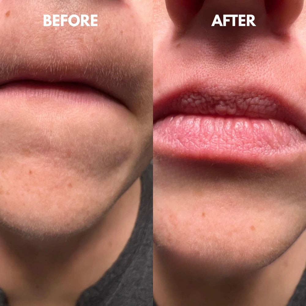 SilkRooter – Gentle, Irritation-Free Facial Hair Removal with Long-Lasting Results