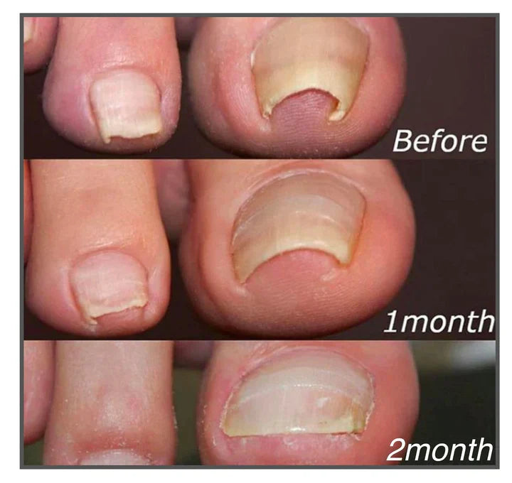 5+5 FREE | FixaNail - Instant Nail Repair
